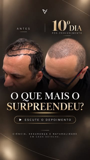 Uma calvície extensa não exige apenas muitos fios. Exige estratégia.

Neste caso, o paciente ainda a