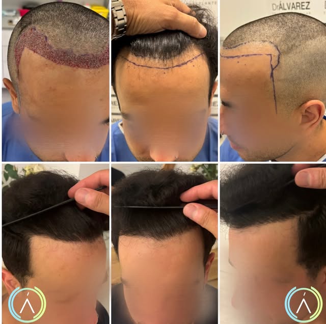 Reconstrucción de la línea frontal y las entradas, respetando las proporciones y los rasgos del paci