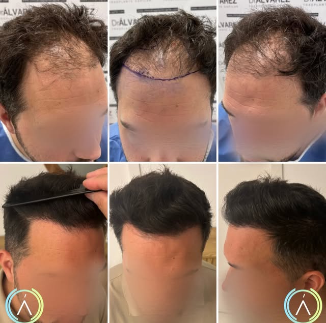 Reconstrucción de la línea frontal y aumento de densidad mediante trasplante capilar, respetando la 