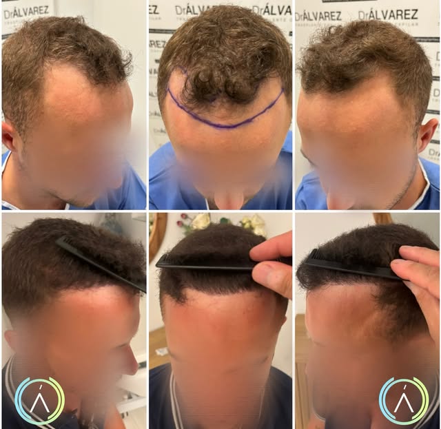 Reconstrucción de la línea frontal y las entradas mediante trasplante capilar, buscando una transici