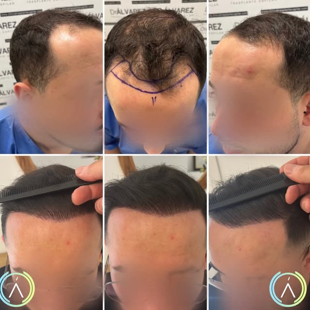 El cabello fino también puede ofrecer un resultado natural y satisfactorio ✨

Cuando el calibre del 