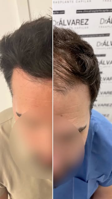 Un cambio natural, respetando siempre la fisonomía del paciente. ✨

Rediseño de la línea frontal y a