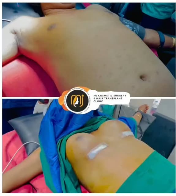 Breast implant in transgender patient