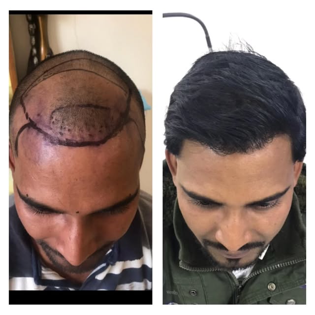 Hair transplant