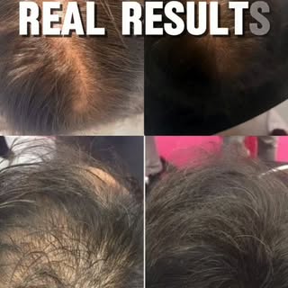 ✨ Healthy Skin & Strong Hair Begin with the Right Diagnosis.

Are you experiencing Hair Fall, Acne, 