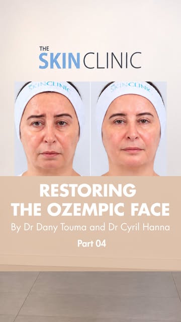 The final stage of Nadine’s facial restoration journey reveals the beautiful rejuvenation of her fac