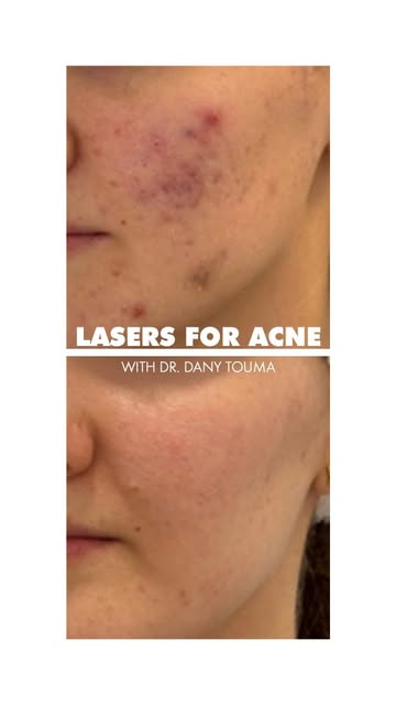 Acne-specific lasers are now established first line treatments for moderate to severe acne, and allo
