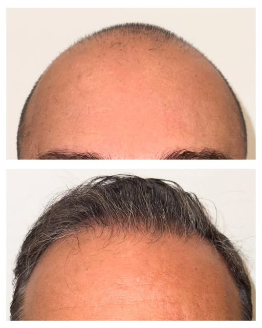 Look at this amazing hair restoration result 9 months after one hair transplantation session
#hairli