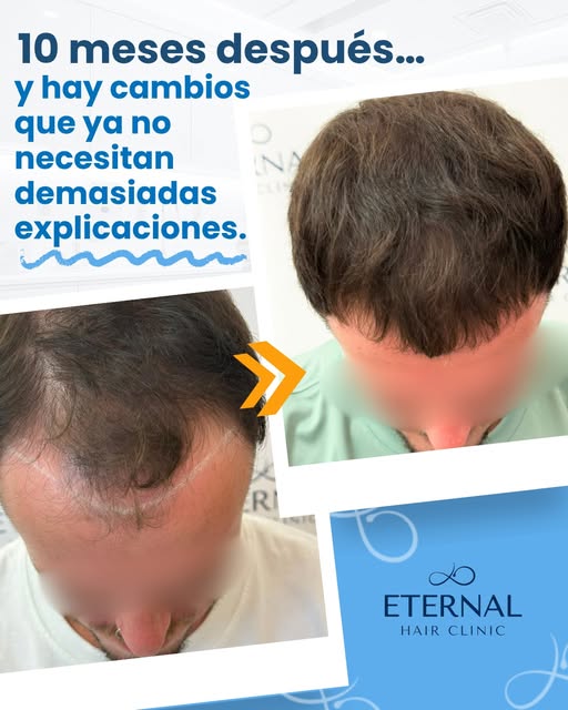 💙 10 meses después… y hay cambios que ya no necesitan demasiadas explicaciones.

Este paciente llev