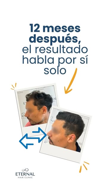 ✨ 12 meses después, el resultado habla por sí solo.

Hoy os mostramos la evolución de uno de nuestro