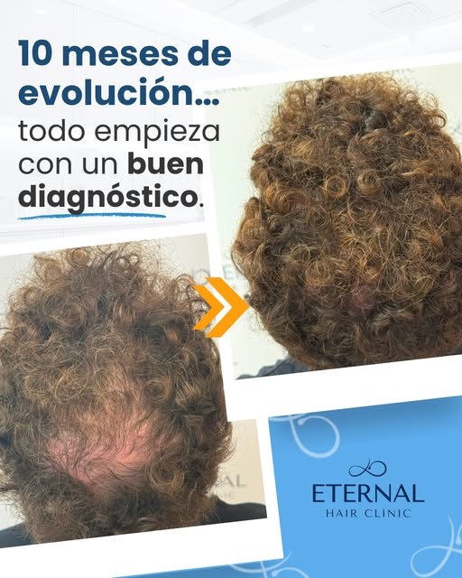 🔬 10 meses de evolución que demuestran por qué todo empieza con un buen diagnóstico.

Cuando un pac