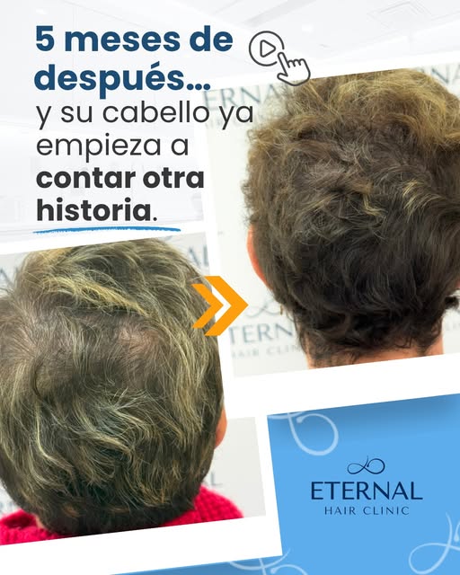 🌸 5 meses después… y su cabello ya empieza a contar otra historia.

La alopecia femenina no afecta 