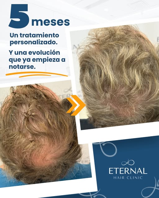 ✨ 5 meses. Un tratamiento personalizado. Y una evolución que ya empieza a notarse.

Cuando hablamos 