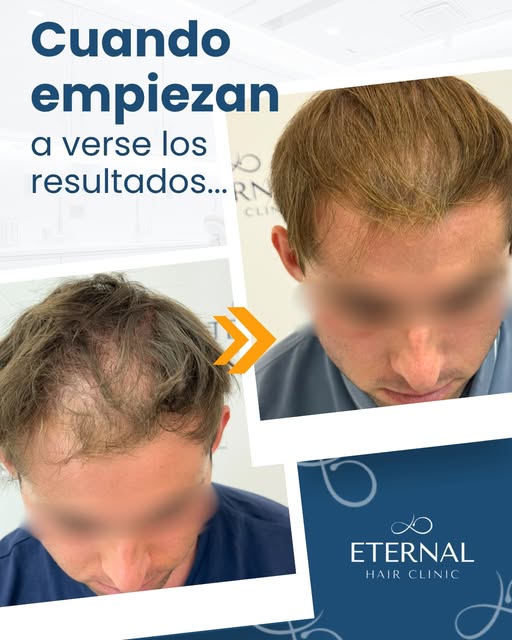 ✨ 4 meses de tratamiento y los primeros cambios ya empiezan a hacerse notar. 🤩

Este paciente comen