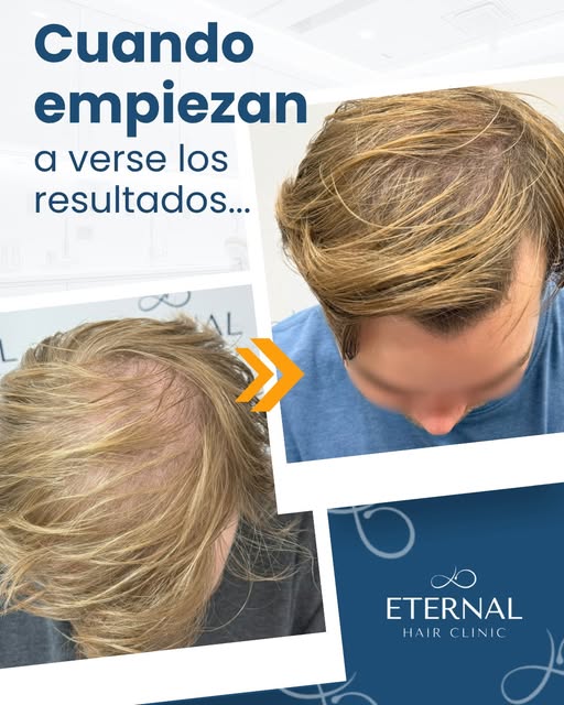 5 meses cuidando el cabello… y la evolución ya se hace visible.

No todos los tratamientos capilares