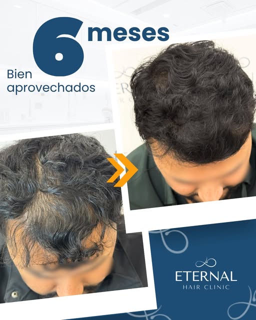 🔥 6 meses después, la diferencia ya es más que evidente.

Este paciente comenzó un tratamiento capi