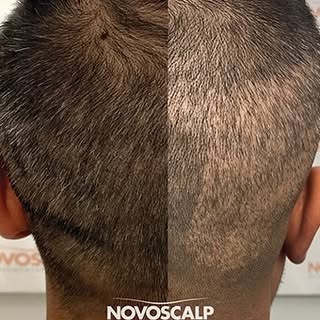GOT LIGHT PATCHES FROM AN FUE TRANSPLANT and want a short back and sides style? An experienced SMP a