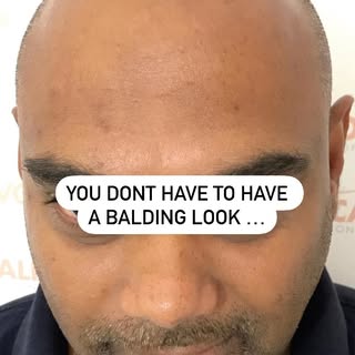 CHOOSE NOT TO LOOK BALD with a Scalp Micropigmentation treatment at Novoscalp Clinics Australia. 

3