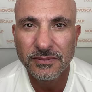 CREATING THE MOST REALISTIC HAIR TATTOO STUBBLE POSSIBLE!⁠
⁠
 At Novoscalp clinics Australia in Sydn