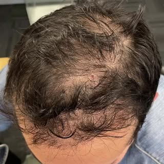 Welcome to Novoscalp Clinics Australia, where we conceal hair loss with Scalp Micropigmentation (aka