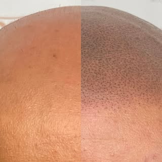WHY PEOPLE ARE CHOOSING NOVOSCALP CLINICS AUSTRALIA FOR THEIR SCALP MICROPIGMENTATION HAIR TATTOO!⁠
