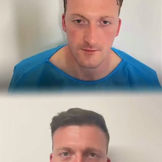 ✨ 12 month review✨ 

Many thanks to my patient for allowing me to share this transformation. 

All s