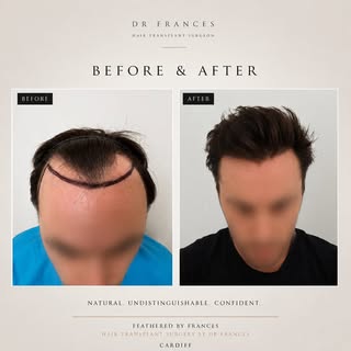I am proud to share this wonderful patients results, 12 months post FUE hair transplant performed by
