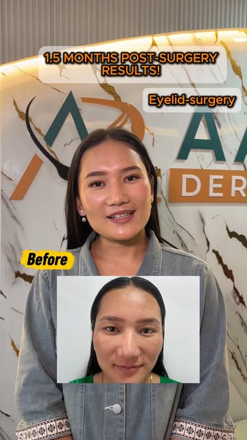 1.5 months after eyelid surgery — and hearing the experience directly from the patient.

From the de