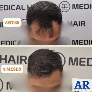 .
CIRUGÍA F.U.E.
🔎 TIPO ALOPECIA: Localizada
📐 GRADO: 2 - escala Hamilton-Norwood
🧮 Nº UNIDADES F