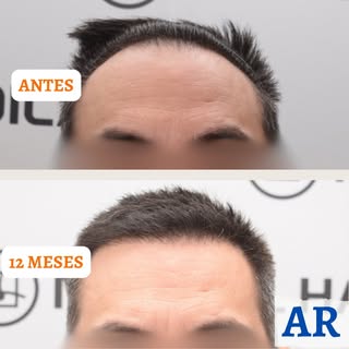 CIRUGÍA F.U.E.
🔎 TIPO ALOPECIA: Localizada
📐 GRADO: 2 - escala Hamilton-Norwood
🧮 Nº UNIDADES FOL