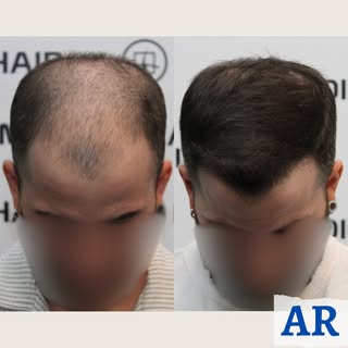 CIRUGÍA F.U.E.
🔎 TIPO ALOPECIA: Localizada (con componente difuso)
📐 GRADO: 5 - escala Hamilton-No