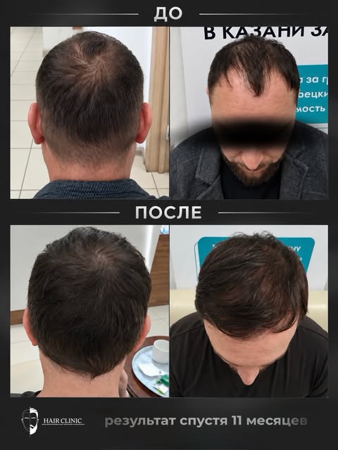 Смотрите, что может сделать пересадка волос всего за 11 месяцев🔥

Сверху - было. Заметные залысины,