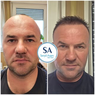 HAIR TRANSPLANT
.
.
.
.
.
#hairtransformation #naturalhair #hairtransplant #hair #trapiantodicapelli