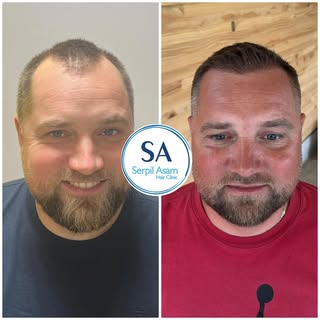 4000 GRAFT FUE HAIR TRANSPLANT 🇸🇮
This could be your before & after.
Natural density. Undetectable