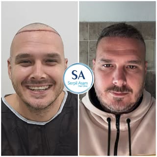 4000 GRAFT FUE HAIR TRANSPLANT IN ISTANBUL TURKEY Natural Hairline and Balanced Density 🇭🇷

Our pa