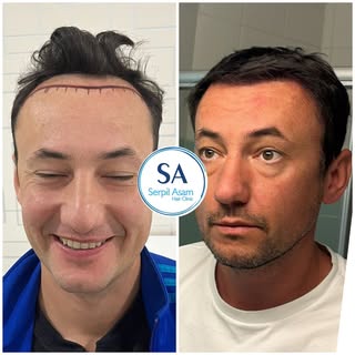 2500 GRAFT FUE 
HAIR TRANSPLANT IN ISTANBUL TURKEY Natural Hairline and Balanced Density 🇸🇮

Our p