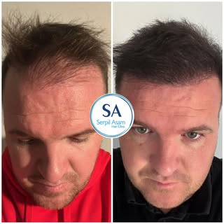 4500 GRAFT FUE 
HAIR TRANSPLANT IN ISTANBUL TURKEY Natural Hairline and Balanced Density 🇸🇮

Our p