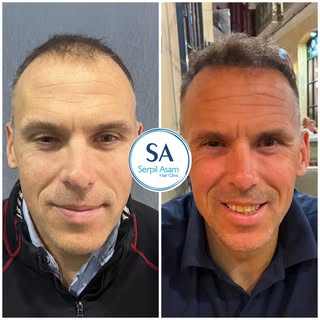 4000 GRAFT DHI 
HAIR TRANSPLANT IN ISTANBUL TURKEY Natural Hairline and Balanced Density 🇸🇮

Our p