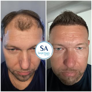 5000 GRAFT FUE
HAIR TRANSPLANT IN ISTANBUL TURKEY Natural Hairline and Balanced Density 🇸🇮

Our pa