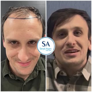 4500 GRAFT FUE
HAIR TRANSPLANT IN ISTANBUL TURKEY Natural Hairline and Balanced Density 🇸🇮

Our pa