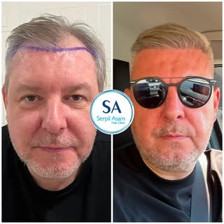 4250 GRAFT FUE
HAIR TRANSPLANT IN ISTANBUL TURKEY Natural Hairline and Balanced Density 🇸🇮

Our pa