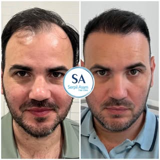 4600 GRAFT FUE
HAIR TRANSPLANT IN ISTANBUL TURKEY Natural Hairline and Balanced Density 🇸🇮

Our pa