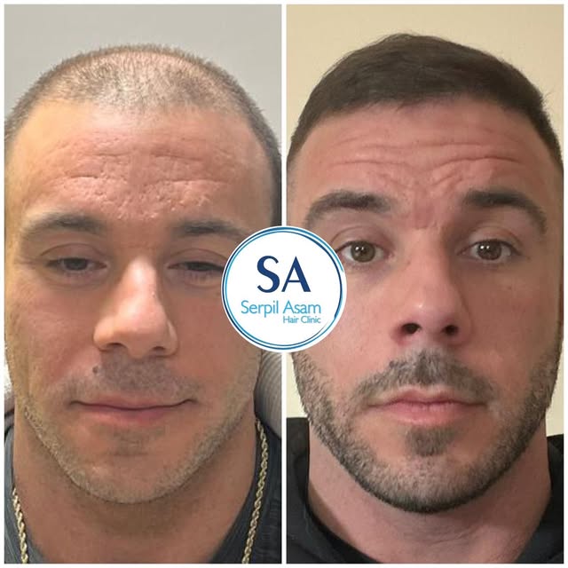 3500 GRAFT FUE
HAIR TRANSPLANT IN ISTANBUL TURKEY Natural Hairline and Balanced Density 

✔️ Persona