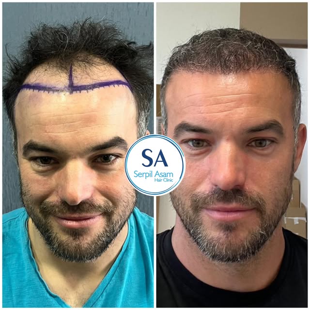 5000 GRAFT FUE
HAIR TRANSPLANT IN ISTANBUL TURKEY Natural Hairline and Balanced Density 🇸🇮

Our pa