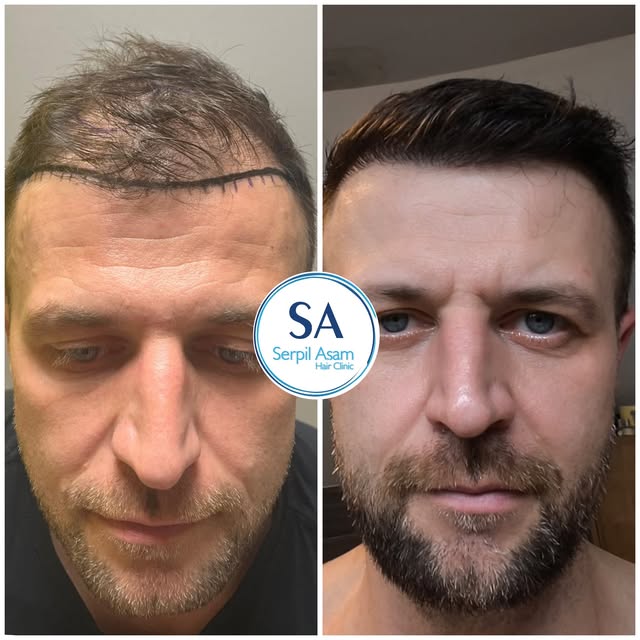 4000 GRAFT 
HAIR TRANSPLANT IN ISTANBUL TURKEY Natural Hairline and Balanced Density 

✔️ Personaliz