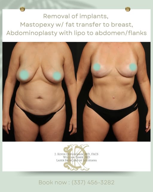 One surgery. A lot of change. ✨

For this patient, we combined:
• Implant removal
• Mastopexy (breas