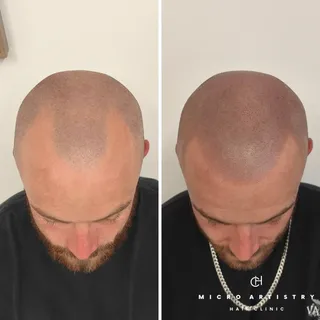 Hairline Restoration | 4th Session Results

Confidence restored ✅😎

Get in touch to arrange a free 