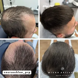 I'll never stop being amazed by @nursechloe_prp 's Platelet-Rich Plasma results 🤯

This patient of 