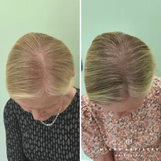 Female Hair Density | 4th Session Results

I LOVE working on blonde hair tones. SMP can help neutral