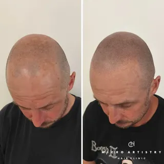 Hairline Restoration | 4th Session Results

Like a new man! 👏 

Get in touch to arrange a free cons